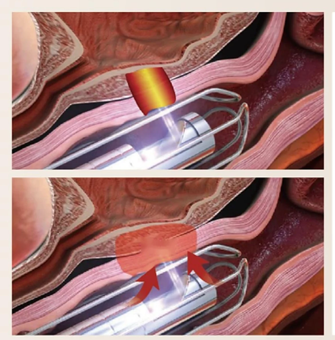 Clinic illustration of a vaginal laser probe sending light into the vaginal wall, then heat spreading in the tissue