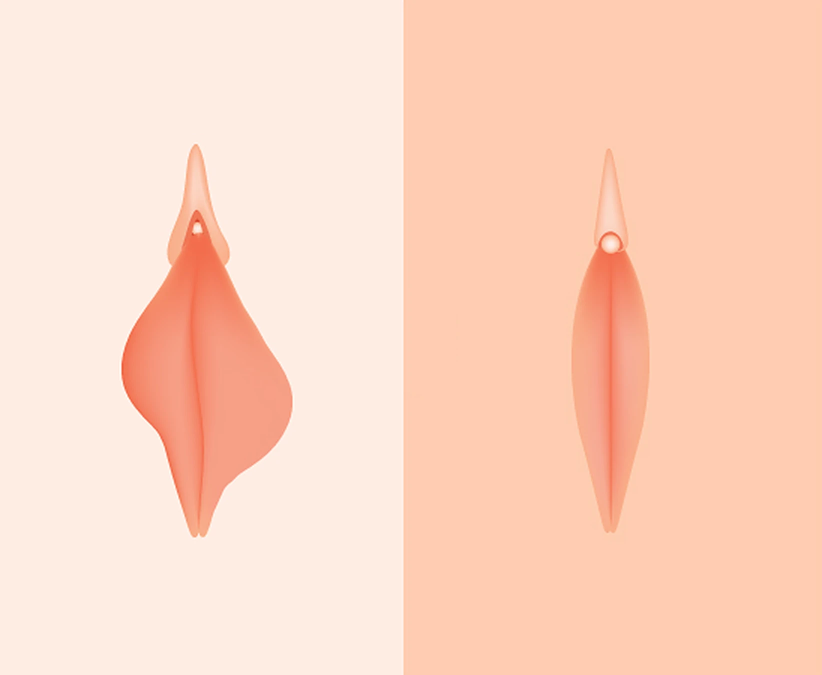 Ilustración de los labios menores: a la izquierda, más largos y asimétricos; a la derecha, con el tamaño y la simetría corregidos.