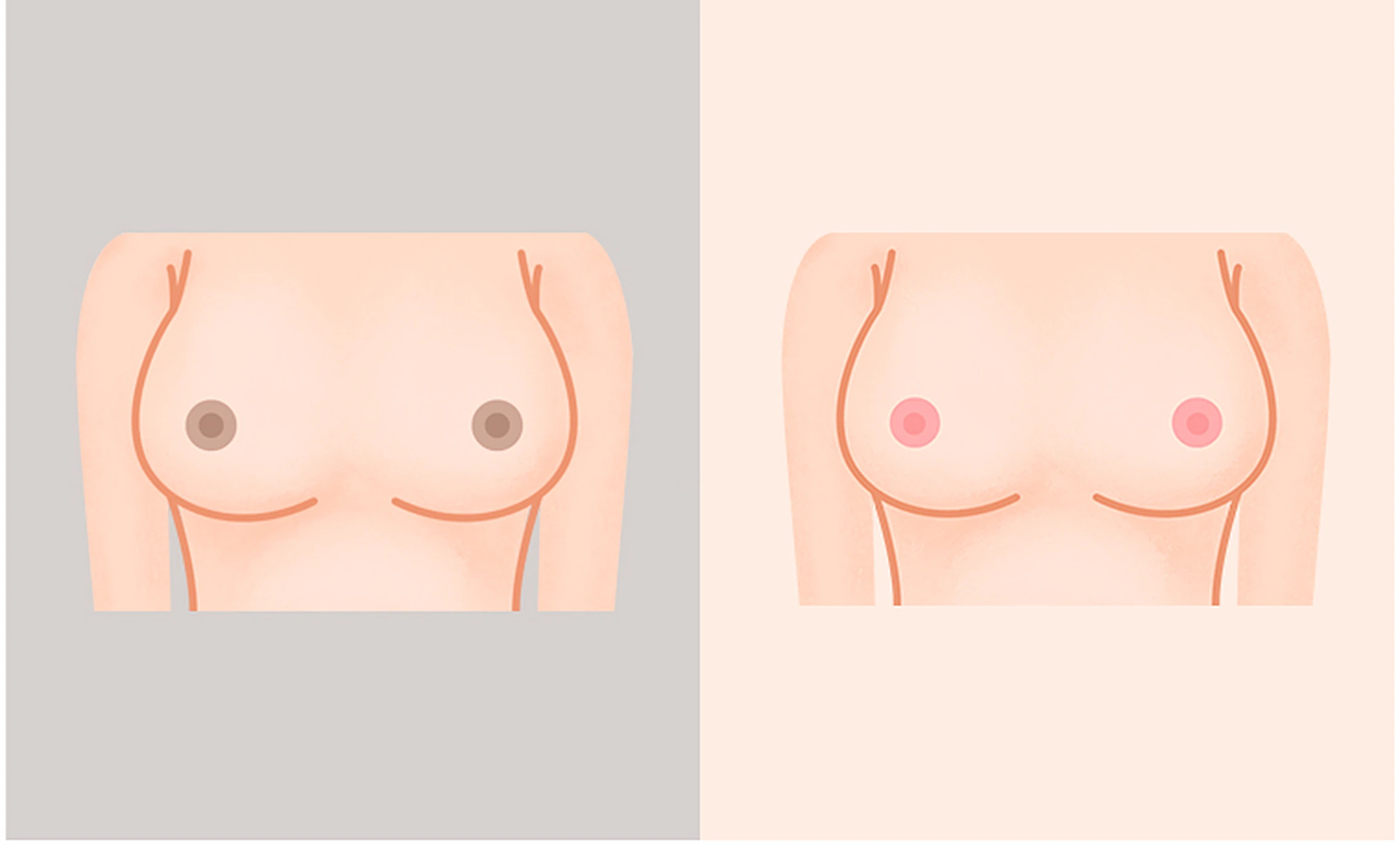 Illustration of areola tone getting lighter and more even
